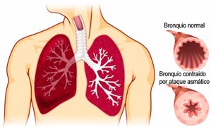 bronquiosasma