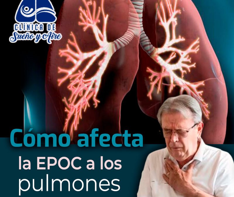 Cómo afecta la EPOC a tus pulmones