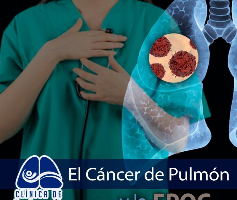 Cáncer de pulmón y EPOC