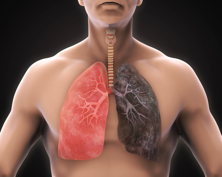 EPOC / Enfisema Pulmonar
